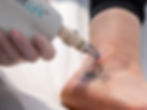 painful laser tattoo removal